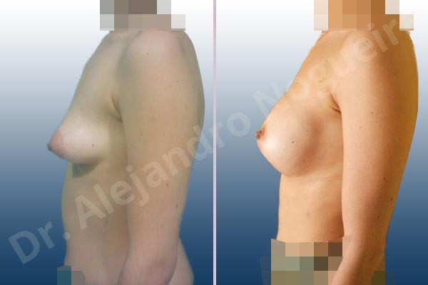 Breast Asymmetry And Galeryrous Breast Correction Explained